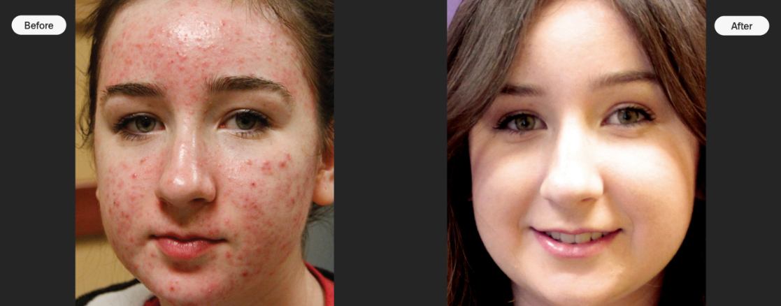 Cutting-edge acne treatment