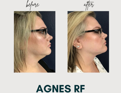 Agnes RF : Microneedling Treatments and Benefits