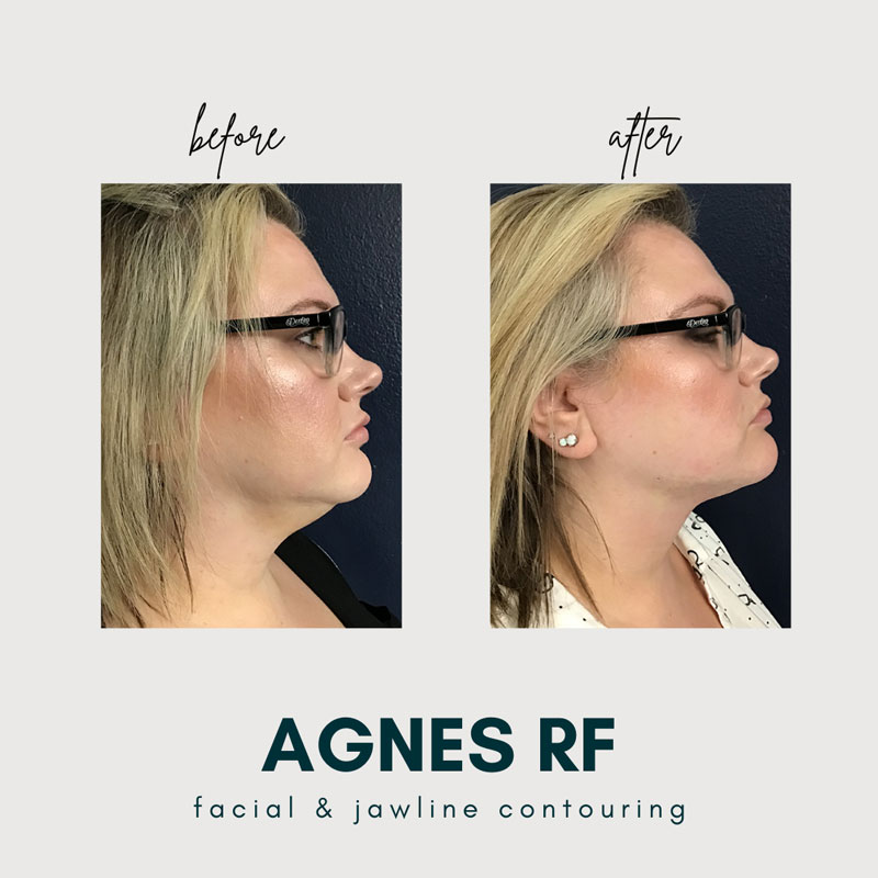 Agnes RF before and after