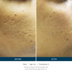 SkinPen is to effectively treat facial acne scars for ages 22 and up
