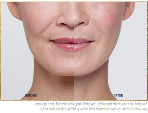Restylane® Lyft : HA Filler Treatments for Hands and Cheeks, Florida