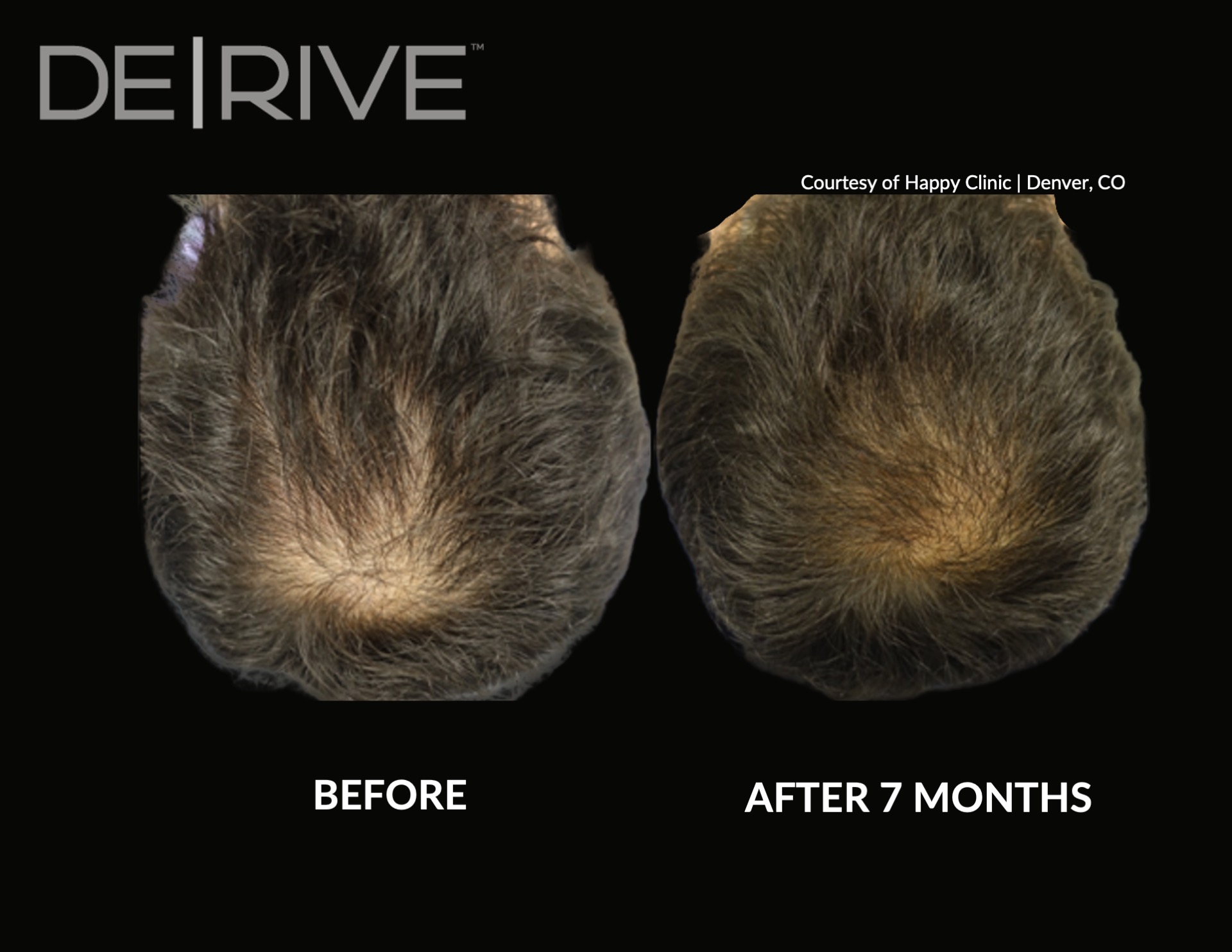 Hair Restoration Process Florida