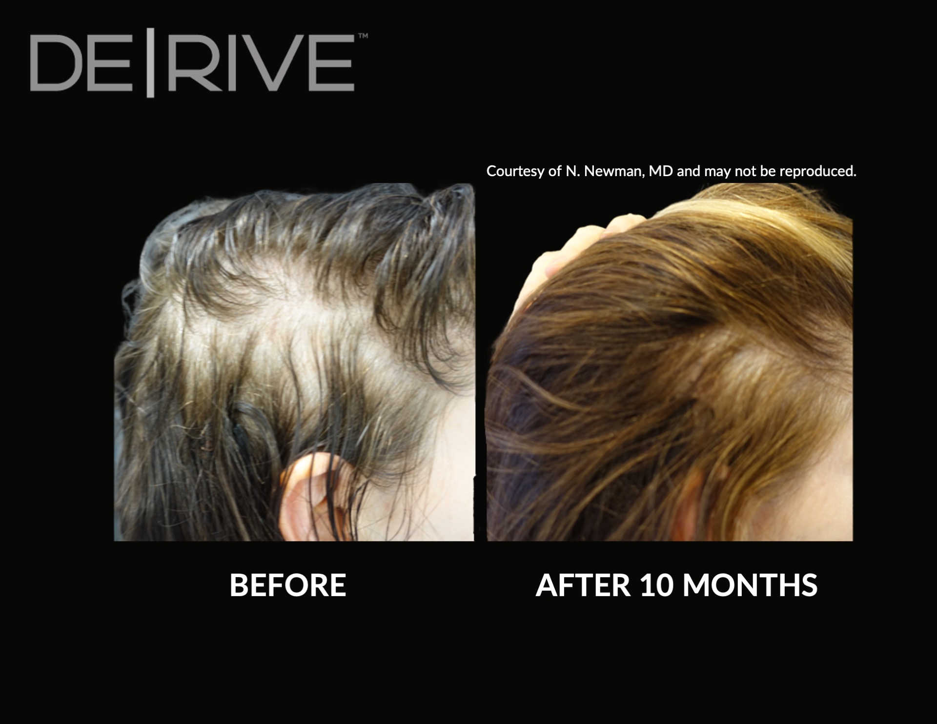 Hair Restoration Florida