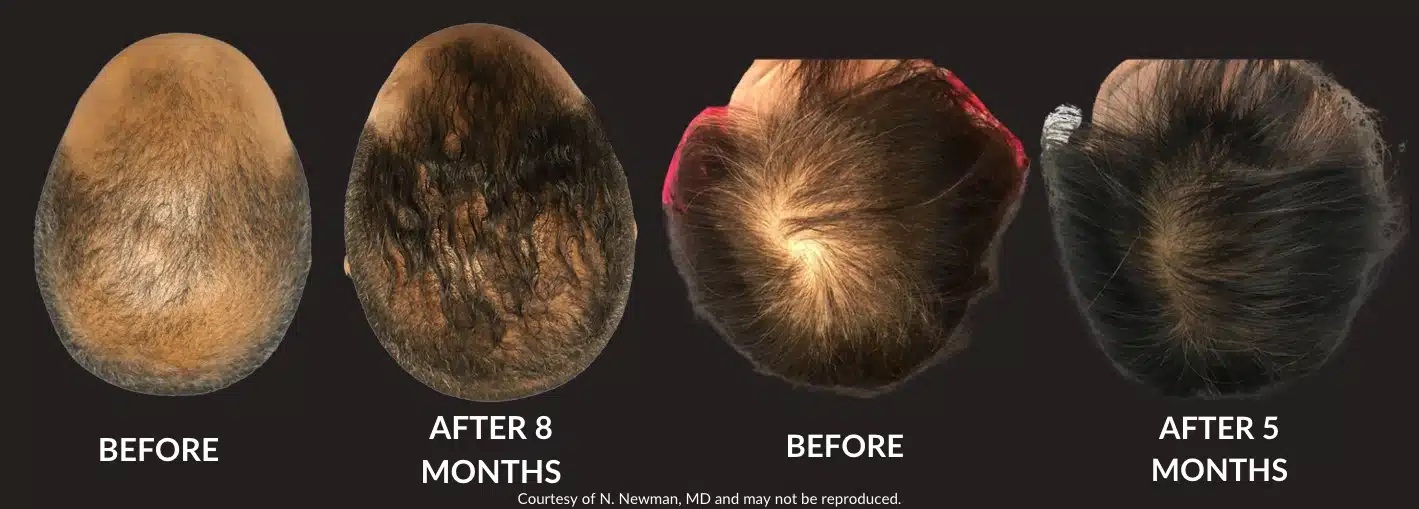 Hair Restoration Step by Step Florida